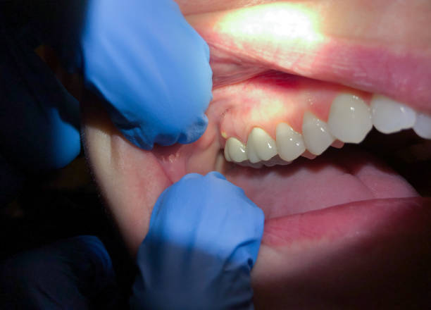 Best Urgent Care for Lost Fillings or Crowns in Delta, OH