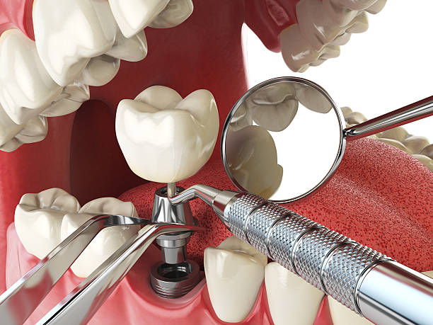 Best Emergency Treatment for Dental Infections or Abscesses in Delta, OH